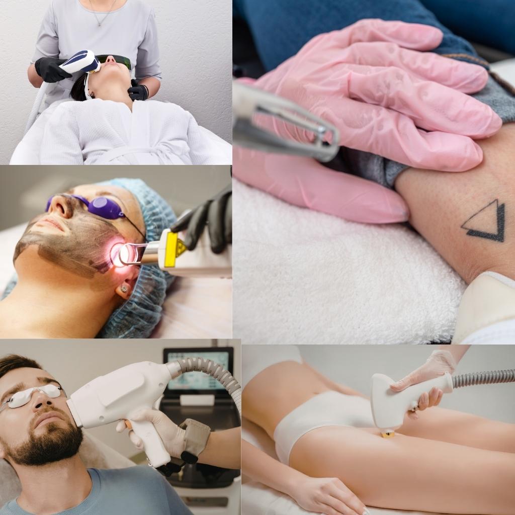 All Types of Laser Treatment