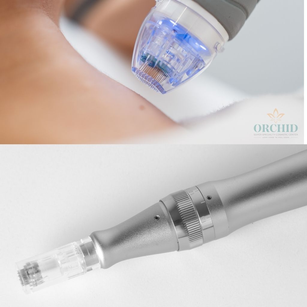 Dermapen Treatment in Kondapur