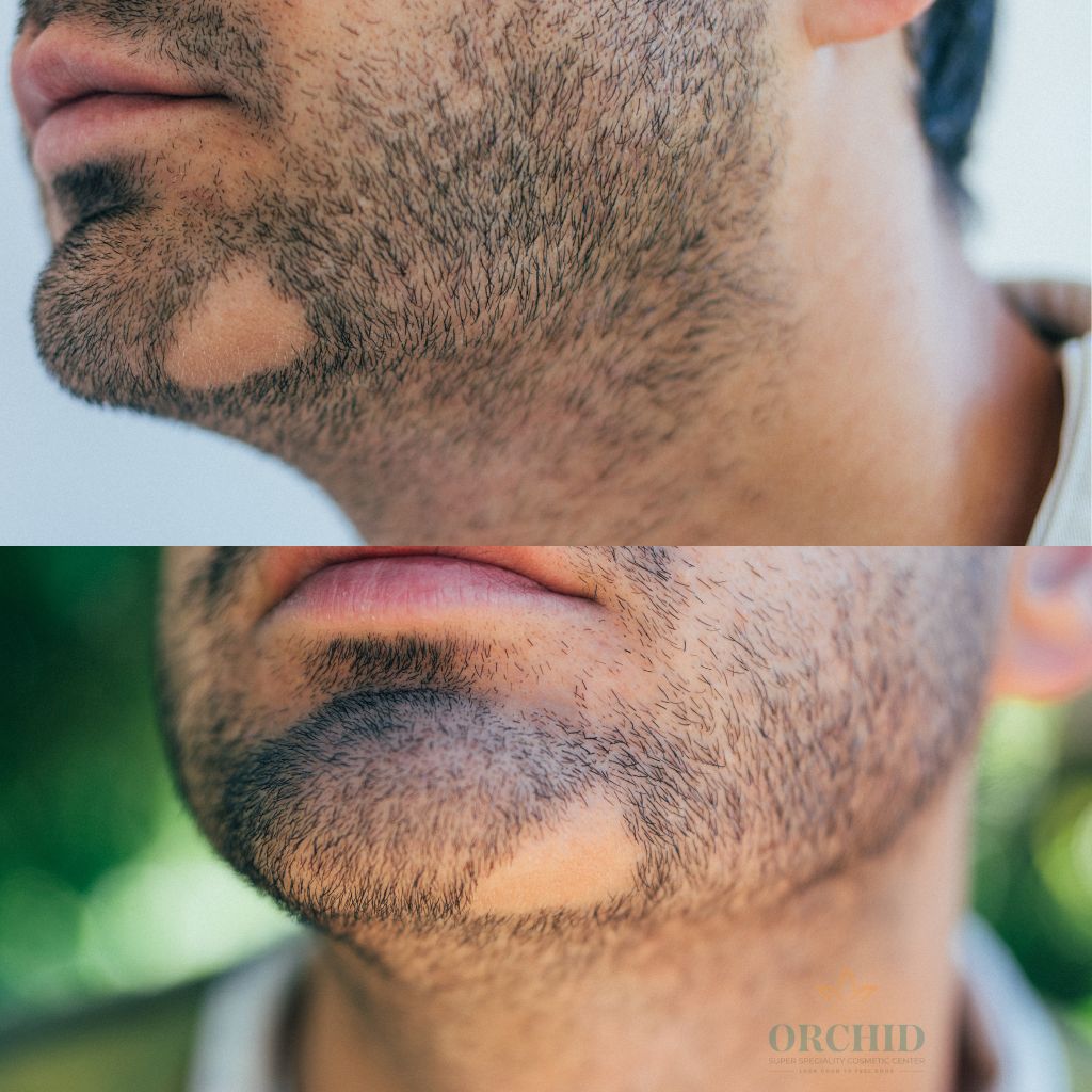 Beard Moustache & Body Hair Transplant in Kondapur at Orchid Cosmetic Clinic