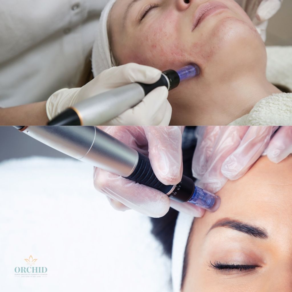 Dermapen Treatment in Kondapur