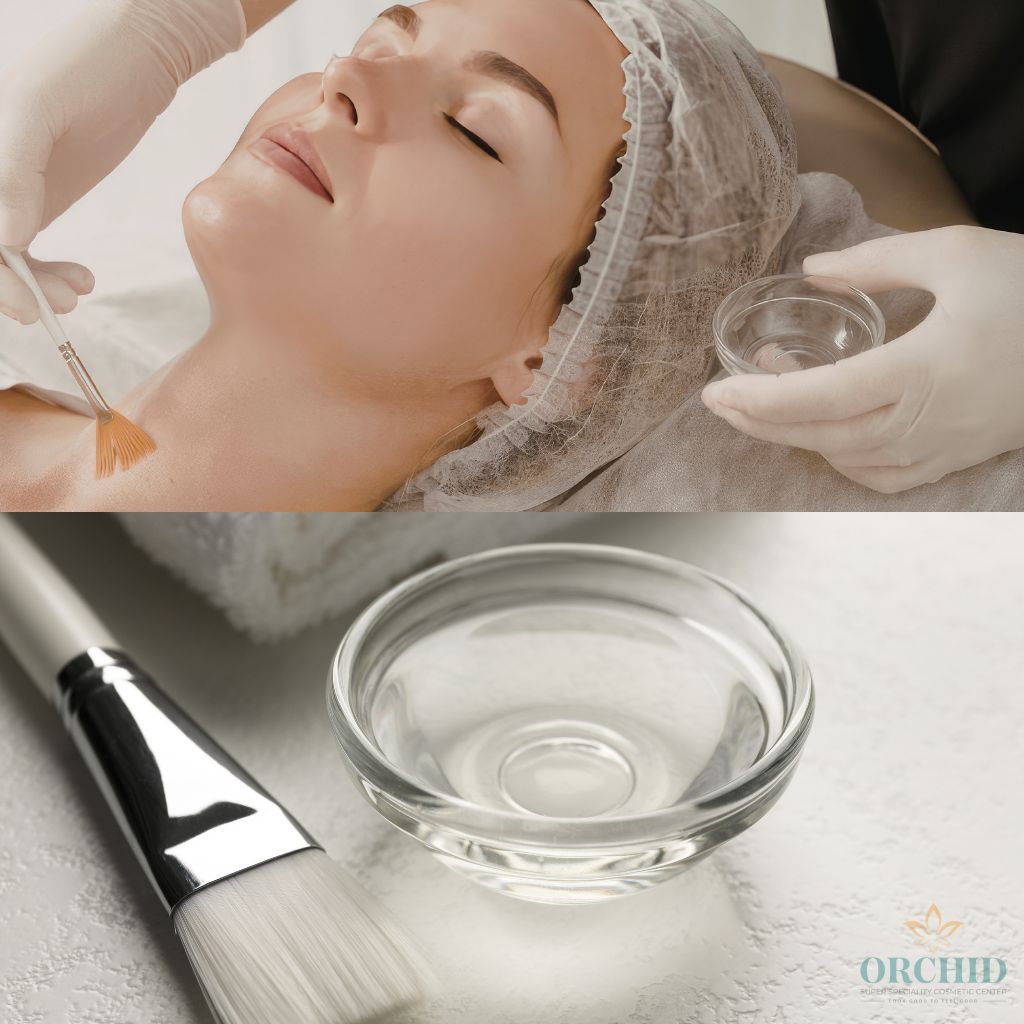Chemical peel in kondapur