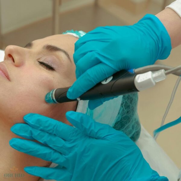 MNRF Microneedling Radiofrequency treatment