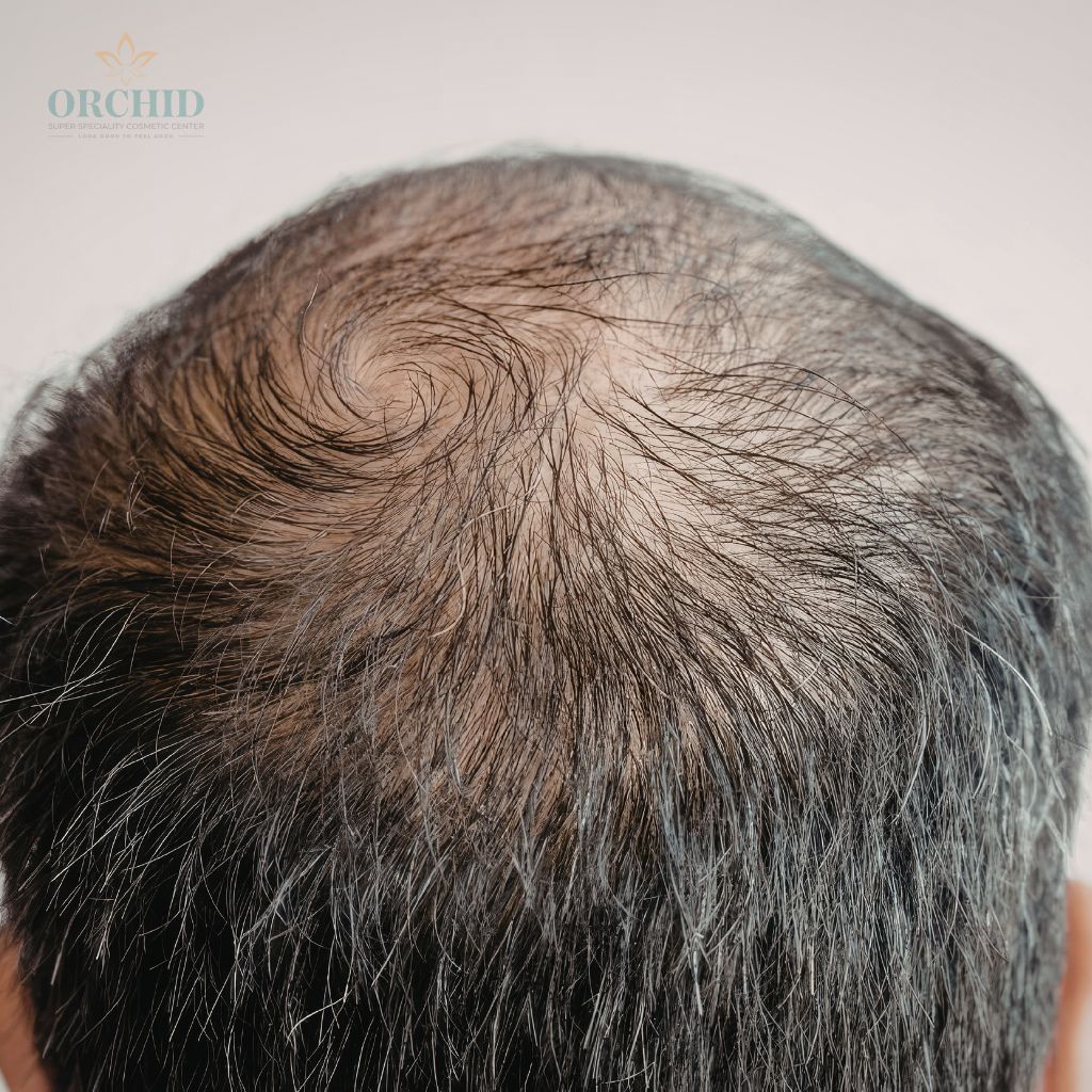 scalp micropigmentation