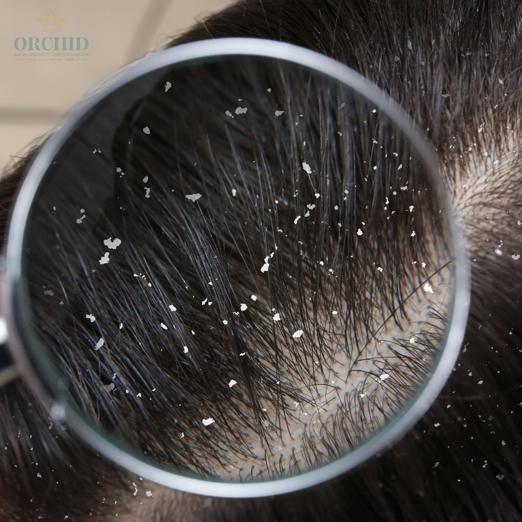 anti-dandruff treatment