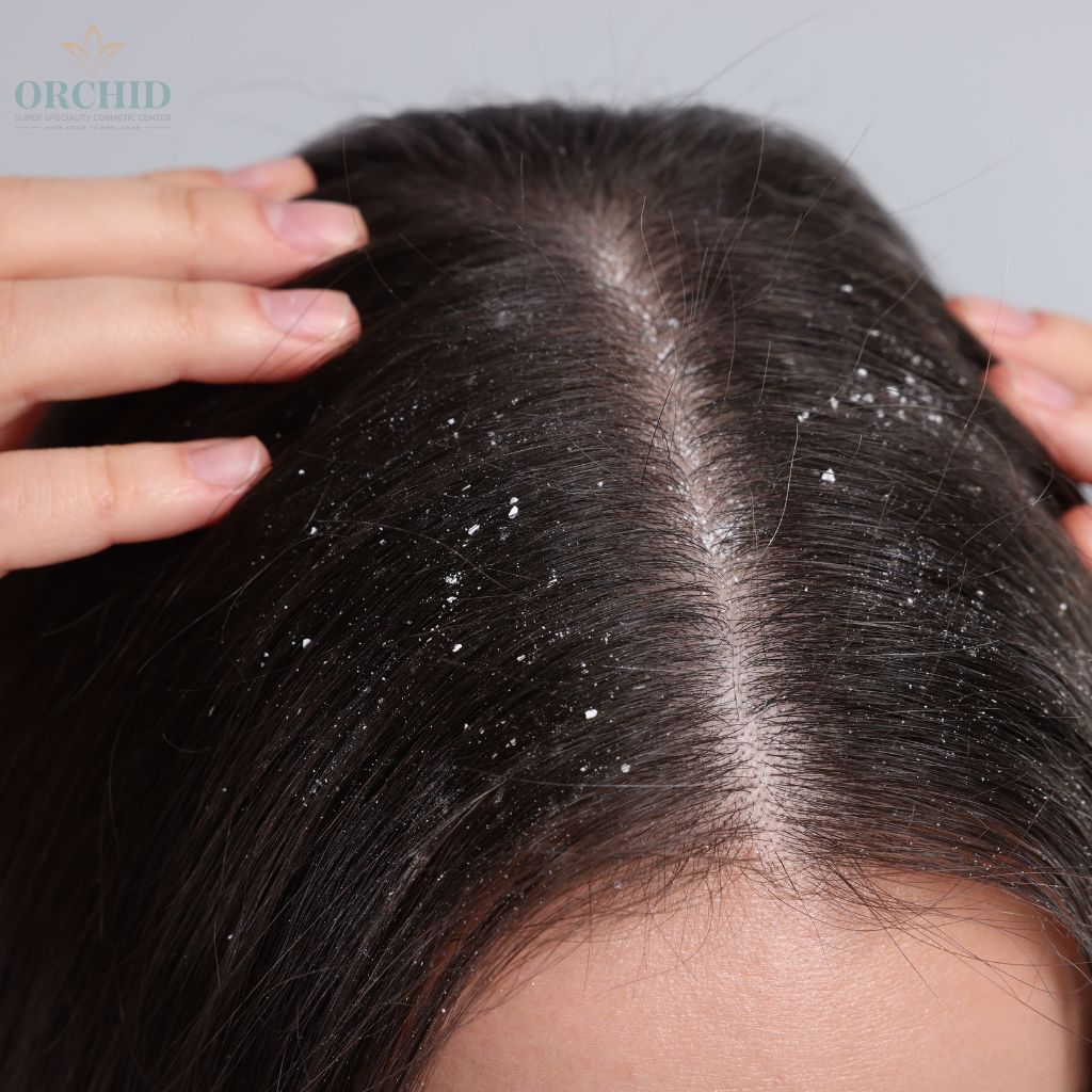 anti dandruff treatment