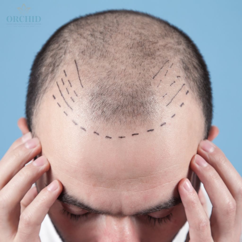 Hair Transplantation
