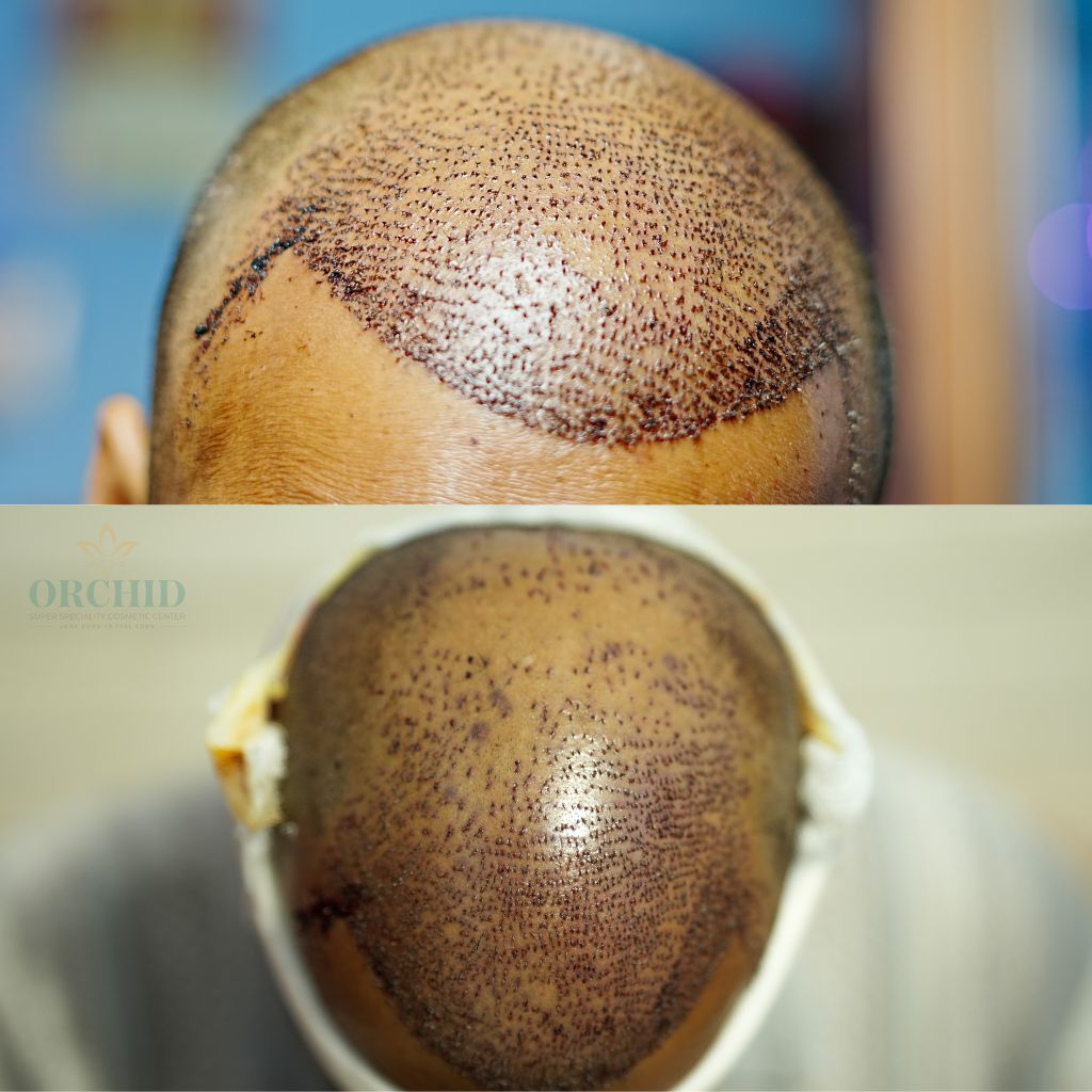 hair transplantation