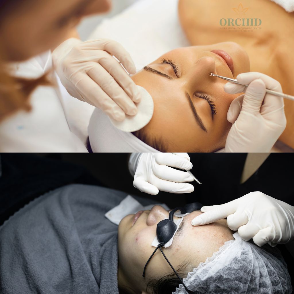 Blackhead & Whitehead Removal Treatment in Kondapur Orchid Cosmetic Clinic