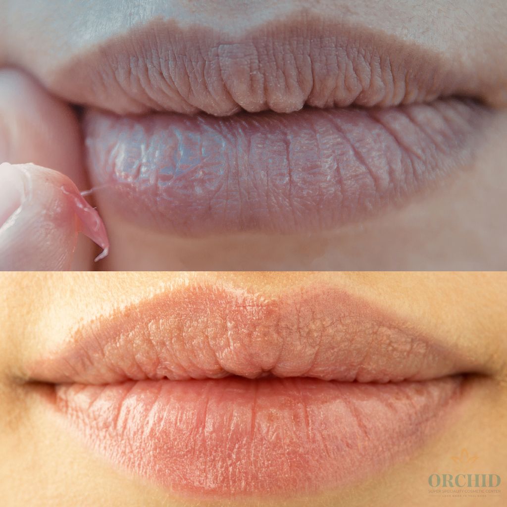 lip pigmentation