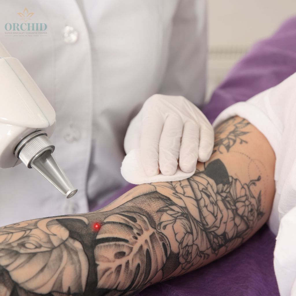 tattoo removal in kondapur