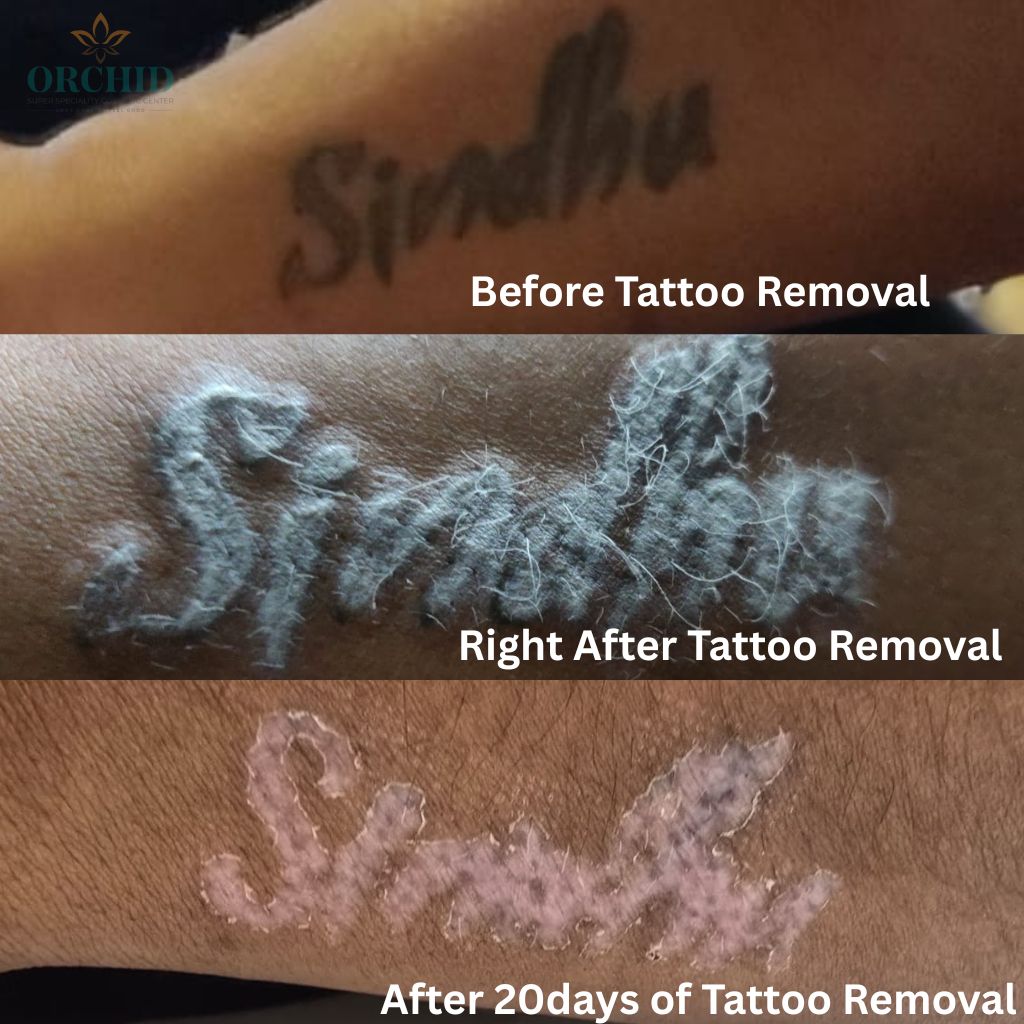 Tattoo Removal Kondapur orchid cosmetic clinic