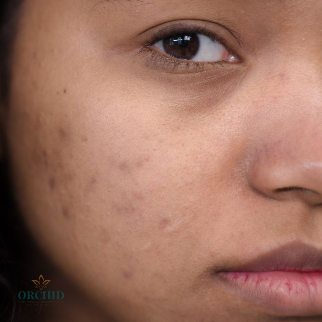 skin lightening treatment Kondapur orchid cosmetic clinic