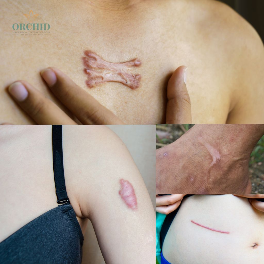 keliods Treatment in kondapur