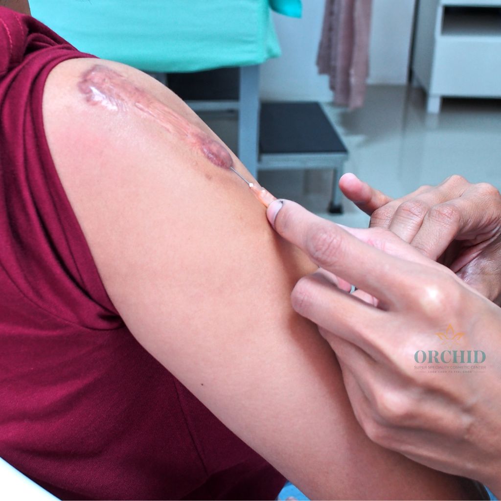 keloids treatment in kondapur