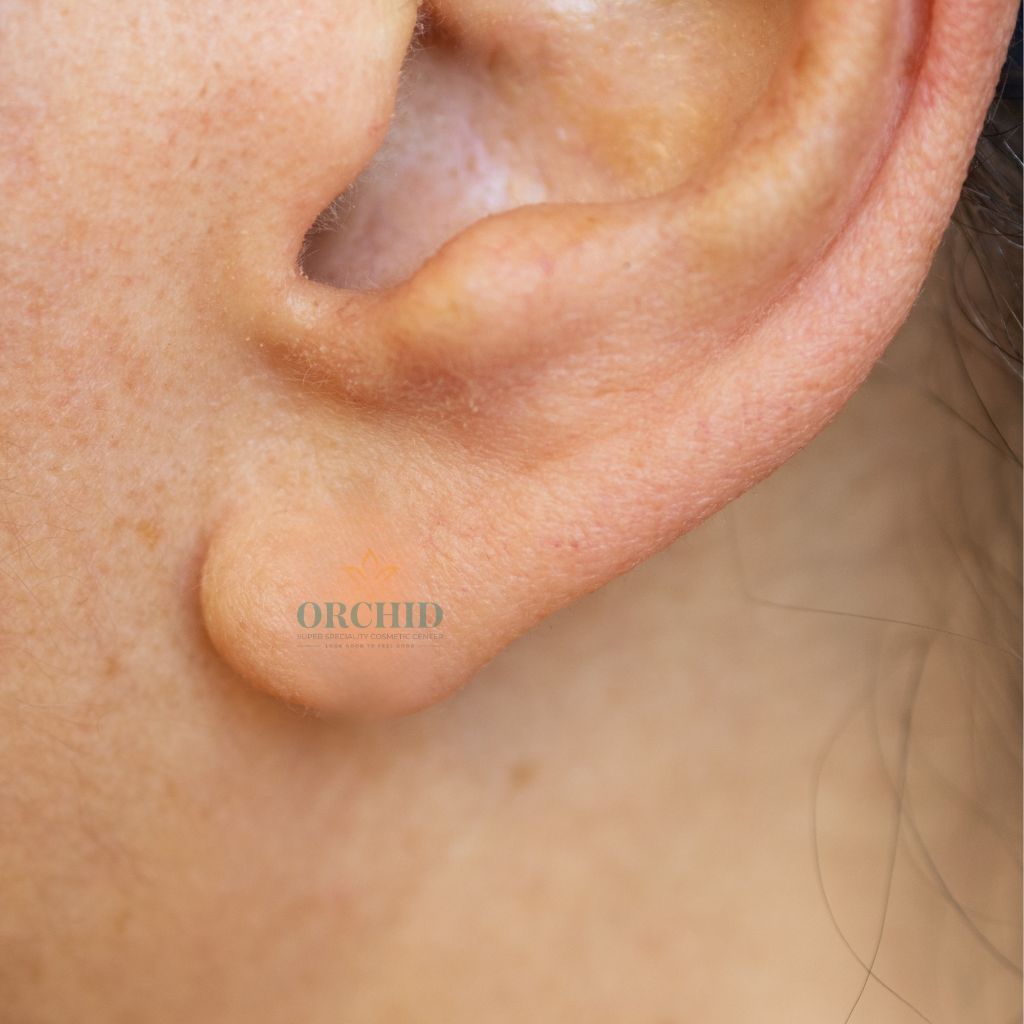 earring hole repair