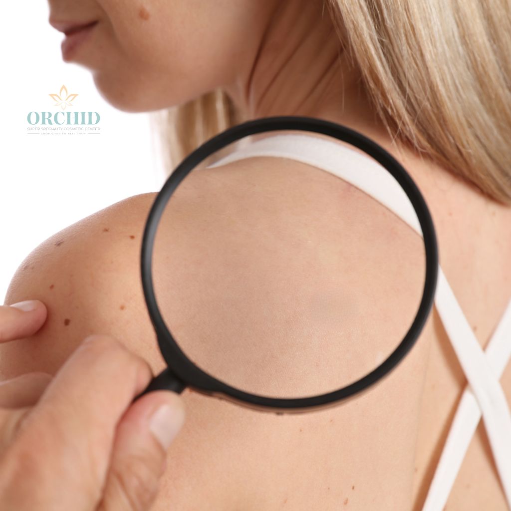 skin tag removal in kondapur orchid clinic