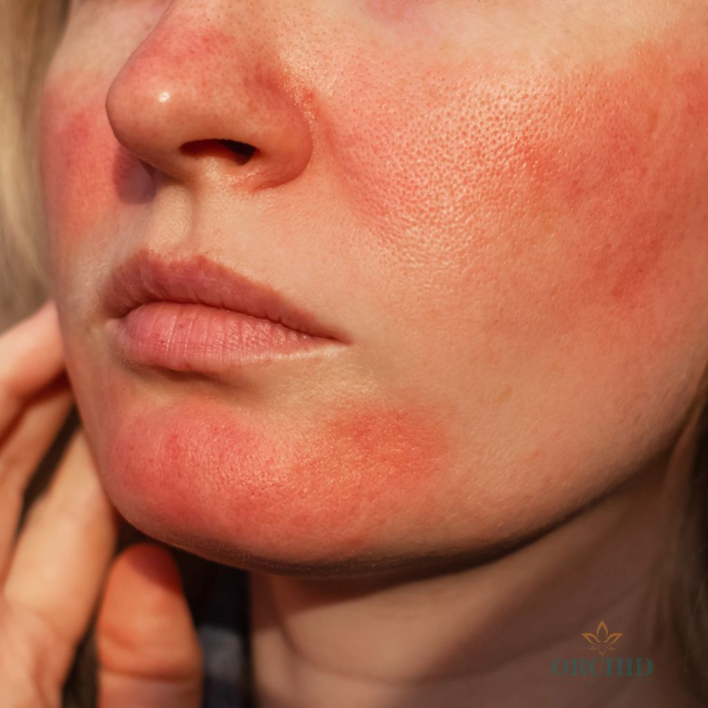 Rosacea Treatment in kondapur
