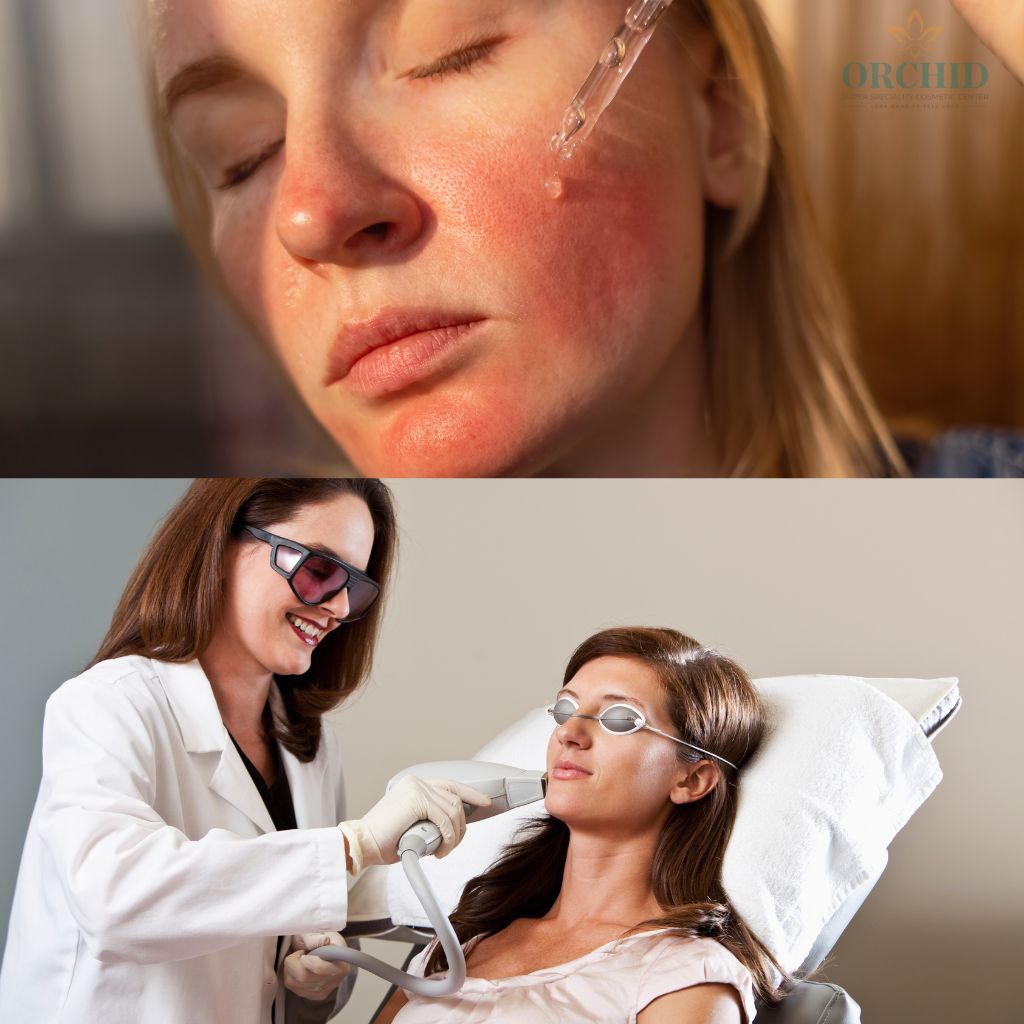 Rosacea Treatment in kondapur