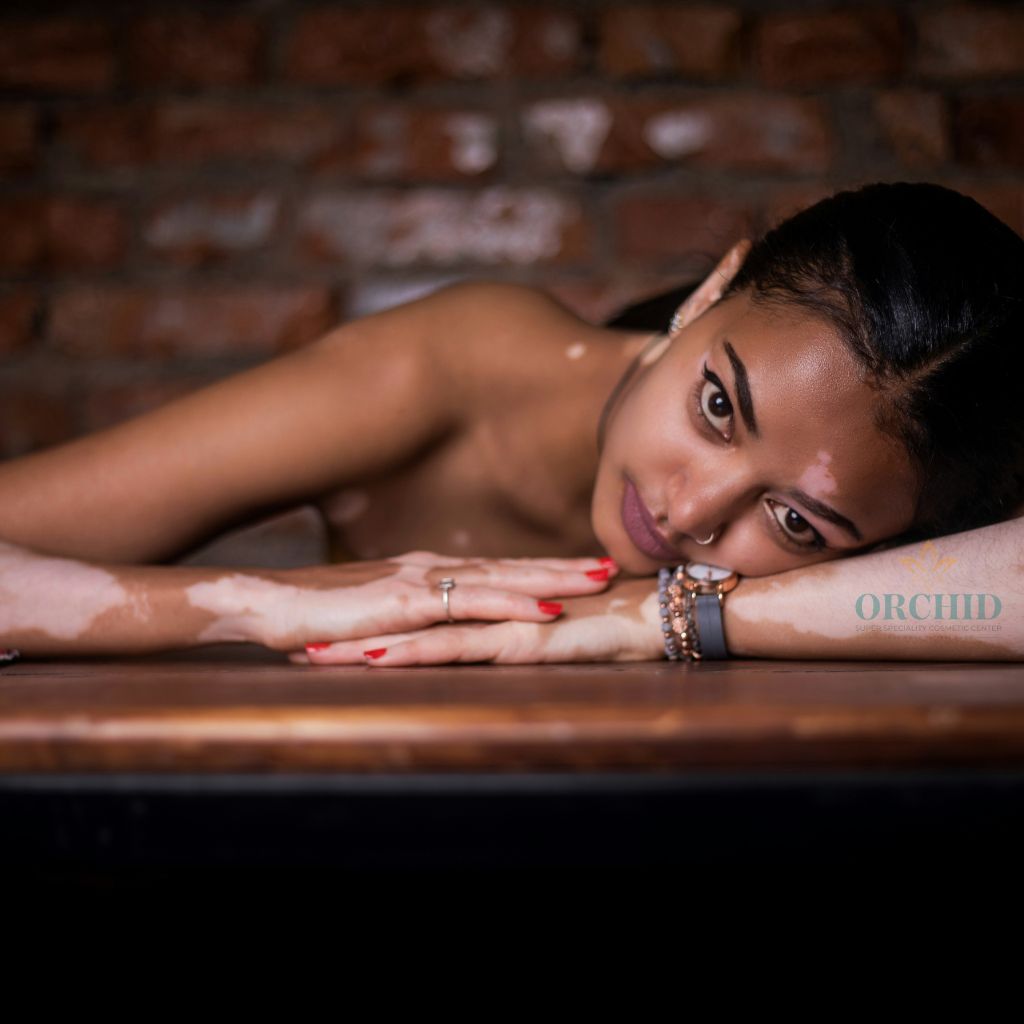 vitiligo treatment in kondapur