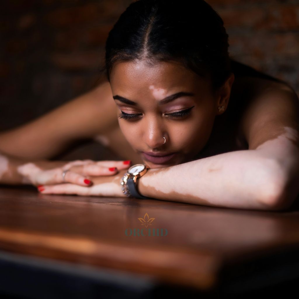 vitiligo treatment in kondapur orchid clinic