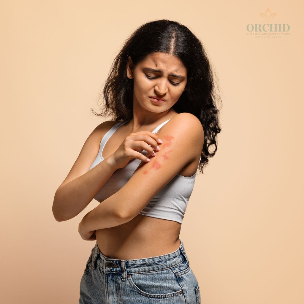 Psoriasis Treatment