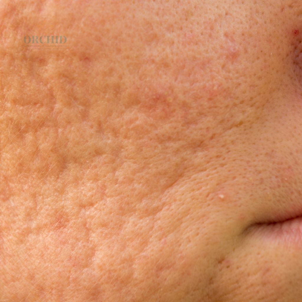 Face Scars Removal in Kondapur