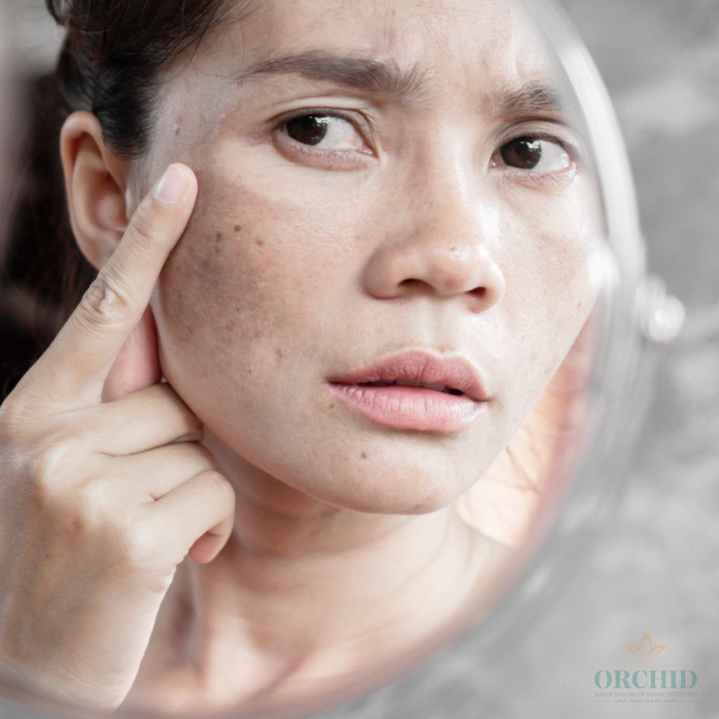 Hyperpigmentation Treatment in kondapur
