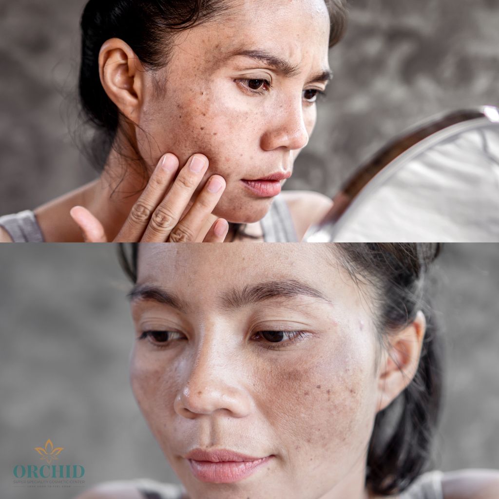Book an Appointment for Melasma Treatment in Kondapur