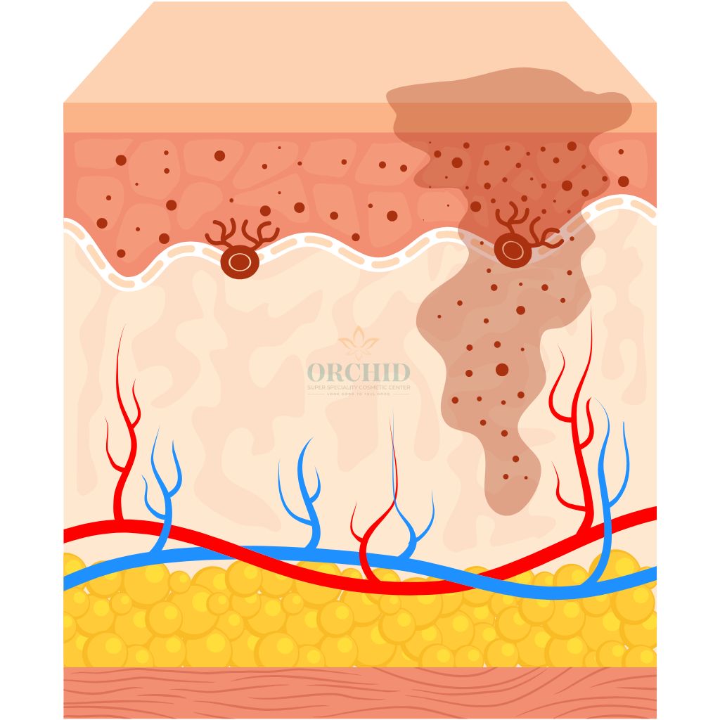 Book an Appointment for Melasma Treatment in Kondapur