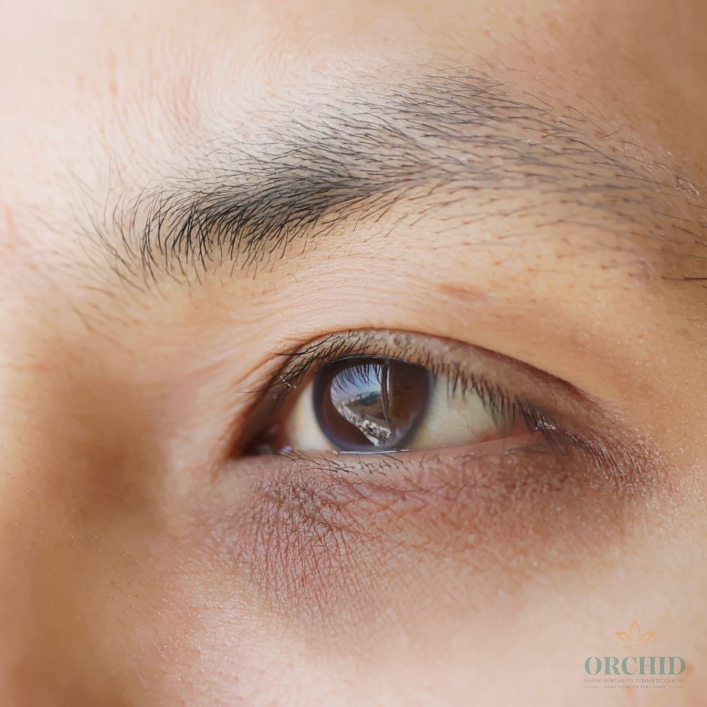 Dark Circles Treatment in Kondapur Orchid Cosmetic Clinic
