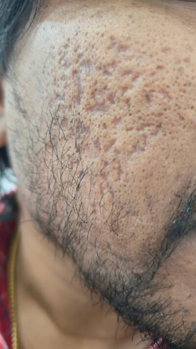 Pimple and Acne Scar removal in Kondapur at Orchid Cosmetic Clinic