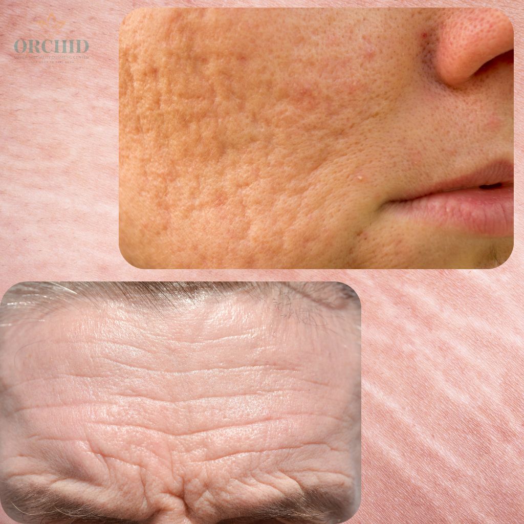 skin micro needling