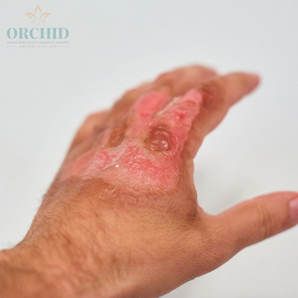 advanced burns treatment