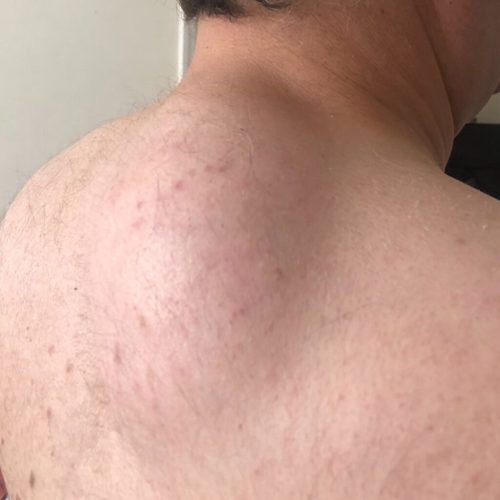 Lipoma-Removal-London-1024x1024